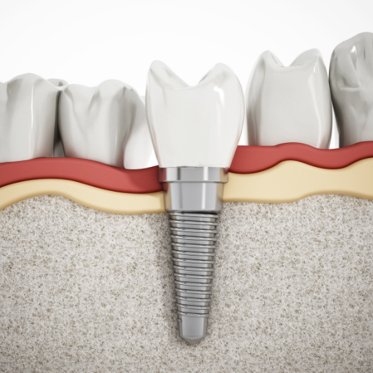 dental implant restoration