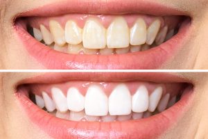 teeth whitening before and after 